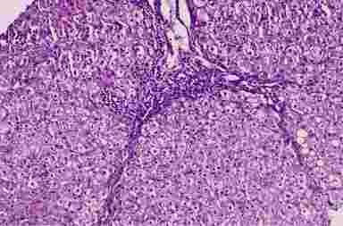 Хронический вирусный гепатит B