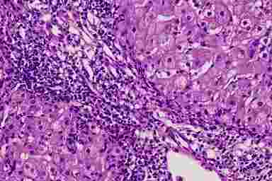 Хронический вирусный гепатит B