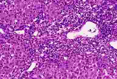 Хронический вирусный гепатит B