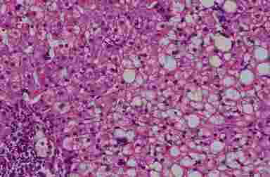 Жировой гепатоз