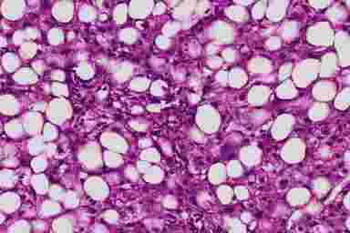 Алкогольная болезнь печени