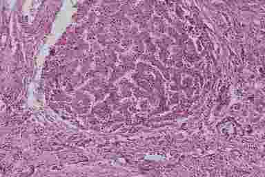 Алкогольный монолобулярный цирроз печени