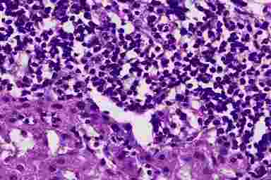 Первичный билиардный цирроз печени