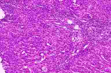 Первичный билиардный цирроз печени