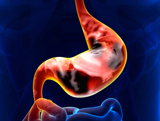 «Русфармтех» завершил 1-ю фазу исследования препарата от рака желудка