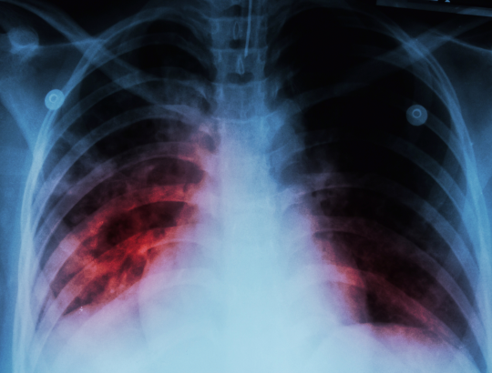 Тоцилизумаб: опыт клинических испытаний