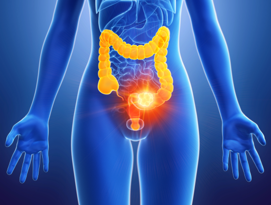 Колоректальный рак: современные подходы к диагностике и лечению