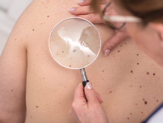 В Иркутске представили бесплатную программу скрининга на меланому кожи