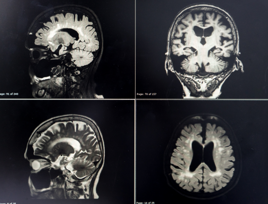 Албендазол — новое описание