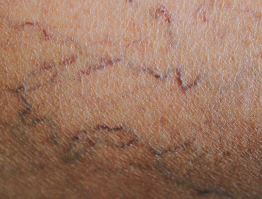 Российские студенты создали визуализатор вен с функцией принятия решения