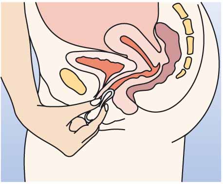 Влагалищное кольцо | Метод контрацепции кольцо